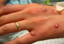 Un bărbat din Craiova a primit diagnosticul de variola maimuței după un test făcut în Germania cu o zi înainte să revină în țară